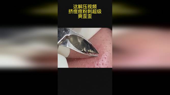最新擠膿包視頻，見證變化的力量，自信與成就感的誕生之地